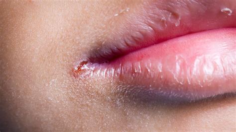 Angular Cheilitis: Symptoms, Causes, and。